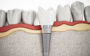 dental implants Albany NY